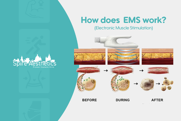 EMS treatment for post pregnancy weight loss treatment Chard