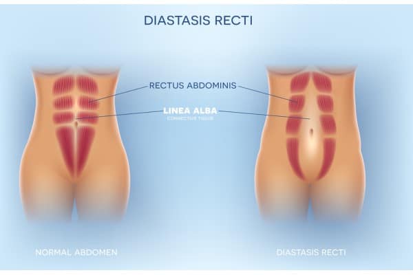 What Non-Surgical Options Are Available for Diastasis Recti Chard?