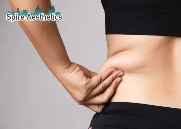 Image of woman pinching fat on their hips Chard. Fat Freezing treatment