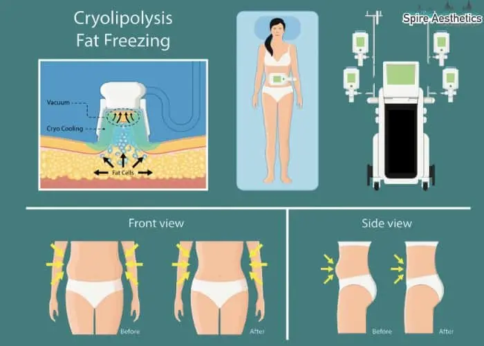 Fat freezing treatment Chard benefits for competitions to remove stubborn fat deposits.