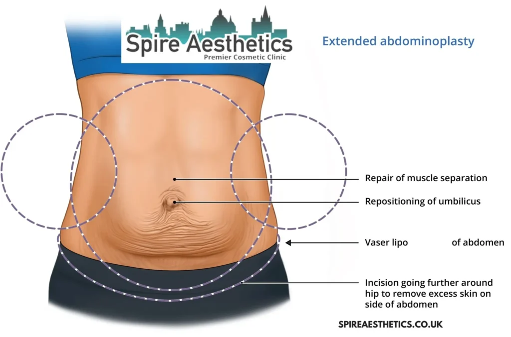 Understanding Loose Skin After Gastric Band Chard Surgery and HIFU Treatment