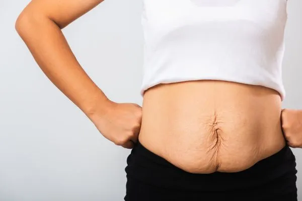 Image of a woman's stomach after weight loss with sagging skin following a gastric band Chard