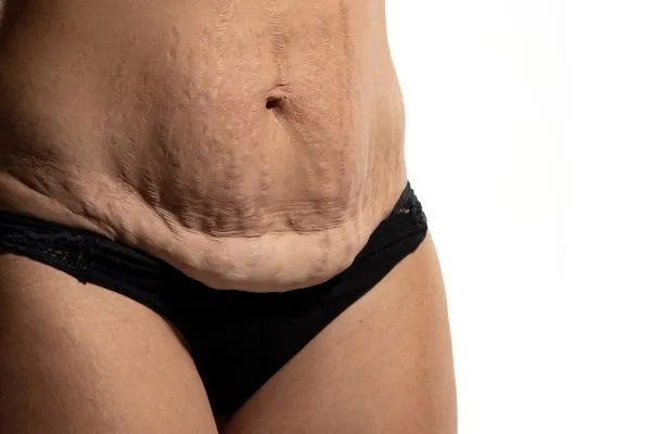 Image of womans stomach after weight loss injections Chard showing saggy skin